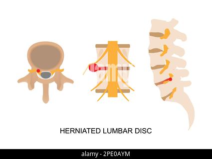 Darstellung des Bandscheibenvorfalls in anderer Sicht. Stock Vektor