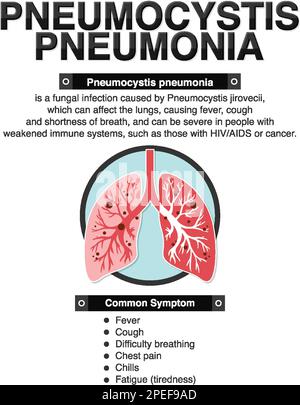 Informationsposter zur Illustration der Pneumocystis-Pneumonie Stock Vektor