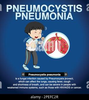 Informationsposter zur Illustration der Pneumocystis-Pneumonie Stock Vektor