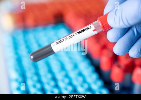 Toxisches Schocksyndrom. Toxic Shock Syndrome Disease Blood Test in einem medizinischen Labor Stockfoto