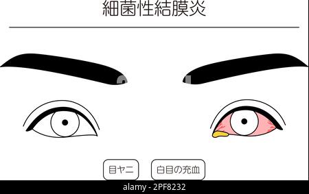 Medical Clipart, Line Drawing Illustration of Eye Disease and Bacterial Conjunctivitis, Vector Illustration Stock Vektor