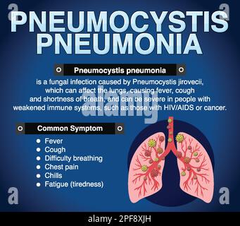 Informationsposter zur Illustration der Pneumocystis-Pneumonie Stock Vektor