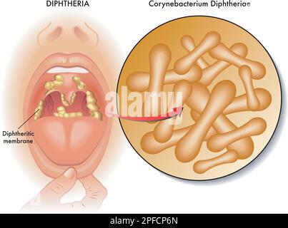 Medizinische Illustration der Symptome der Diphtherie, mit Anmerkungen. Stock Vektor