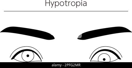 Medizinische Illustrationen, schematische Linienzeichnungen von Augenerkrankungen, Schielen und Hypotropie, Vektordarstellung Stock Vektor