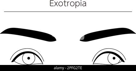 Medizinische Illustrationen, schematische Linienzeichnungen von Augenerkrankungen, Schielen und Exotropie, Vektordarstellung Stock Vektor