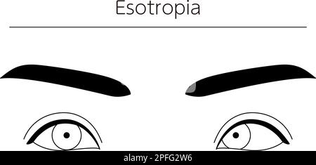 Medizinische Illustrationen, schematische Linienzeichnungen von Augenerkrankungen, Schielen und Esotropie, Vektordarstellung Stock Vektor