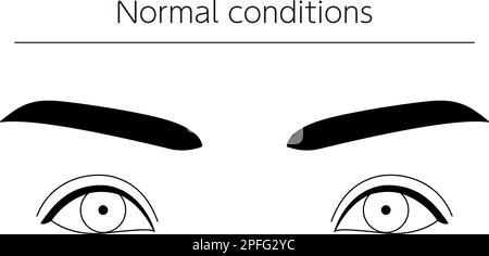 Medizinische Illustrationen, schematische Linienzeichnungen von Augenerkrankungen, Schielen und Normalbedingungen, Vektordarstellung Stock Vektor