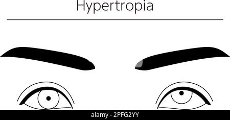 Medizinische Illustrationen, schematische Linienzeichnungen von Augenerkrankungen, Schielen und Hypertropie, Vektordarstellung Stock Vektor