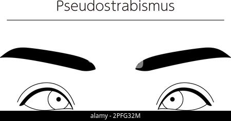 Medizinische Illustrationen, schematische Linienzeichnungen von Augenerkrankungen, Schielen und Pseudostrabismus, Vektordarstellung Stock Vektor