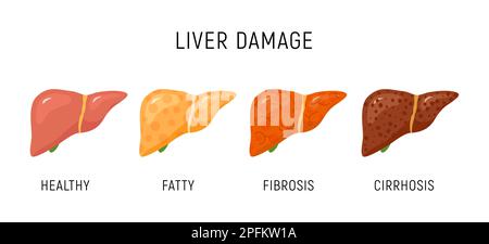 Leberschäden Infographisches Diagramm zur Anatomie der Krebserkrankungen. Leberschädigung Organgewebe Leberkarzinomfibrose-Stadien. Stock Vektor