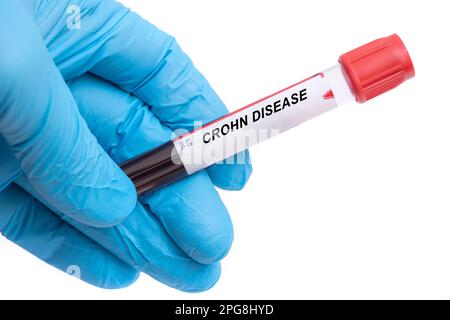 Morbus Crohn. Morbus-Crohn-Bluttest in der Arzthand Stockfoto