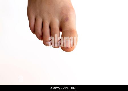 Nahaufnahme des rechten Fußes auf weißem Hintergrund. Erkrankungen der Nägel und Knochen, Padagra Stockfoto