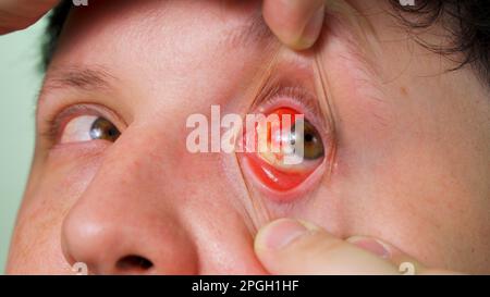 Infektion oder Verletzung des menschlichen Auges, Makro-Nahaufnahme Stockfoto