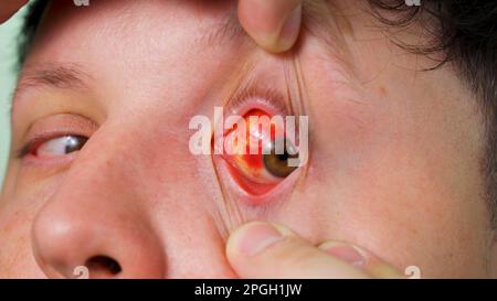 Infektion oder Verletzung des menschlichen Auges, Makro-Nahaufnahme Stockfoto