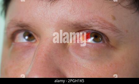 Infektion oder Verletzung des menschlichen Auges, Makro-Nahaufnahme Stockfoto