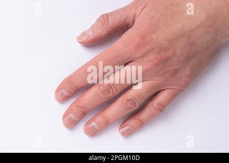 Nahaufnahme von weiblichen altersbezogenen Händen mit natürlich gebrochenen ungesunden, erkrankten Nägeln, überwucherter Kutikula auf weißem Hintergrund, Draufsicht, Kopierraum. Die Hand Stockfoto