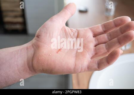 Ein Schnitt an der Handfläche eines Mannes in Nahaufnahme. Hautschäden im Haushalt durch scharfkantige Schneidegegenstände, erste Hilfe Stockfoto