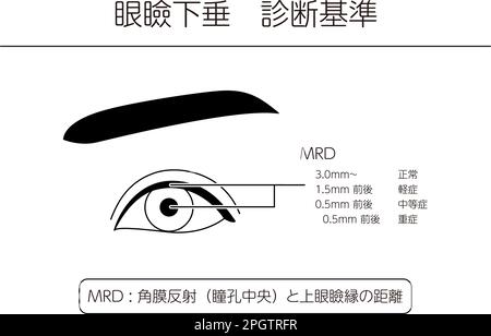 Medizinische Illustration: Diagramm einer schweren Ptosis ...