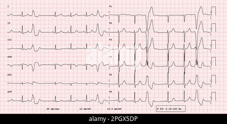 EKG-Beispiel eines 12-Kanal-Rhythmus, breiter QRS-Komplex, supraventrikuläre Extrasystolie, reale Untersuchung Stockfoto