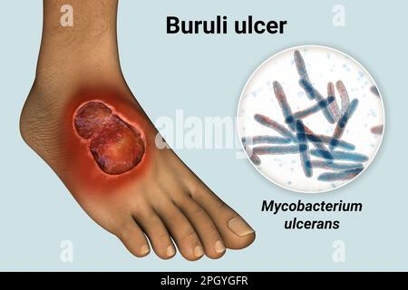 Buruli-Ulkus und Mycobacterium ulcerans, Illustration Stockfoto