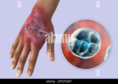 Protothekose-Infektion an einer menschlichen Hand, Illustration Stockfoto