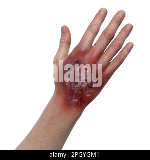 Protothekose-Infektion an einer menschlichen Hand, Illustration Stockfoto