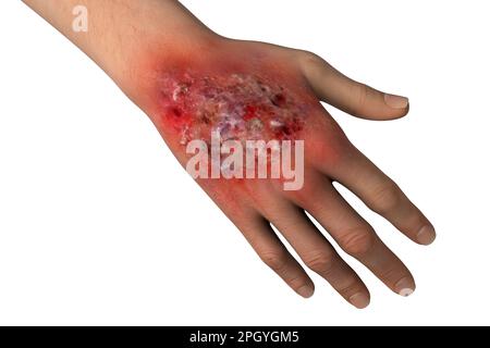 Protothekose-Infektion an einer menschlichen Hand, Illustration Stockfoto