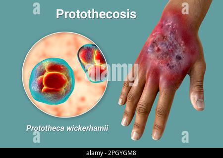Protothekose-Infektion an einer menschlichen Hand, Illustration Stockfoto