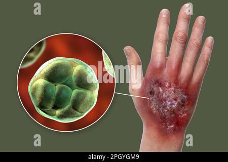 Protothekose-Infektion an einer menschlichen Hand, Illustration Stockfoto