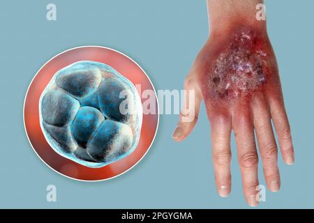 Protothekose-Infektion an einer menschlichen Hand, Illustration Stockfoto