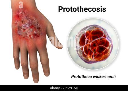 Protothekose-Infektion an einer menschlichen Hand, Illustration Stockfoto