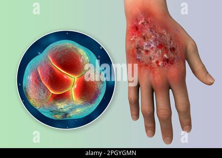 Protothekose-Infektion an einer menschlichen Hand, Illustration Stockfoto