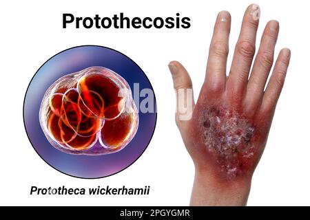 Protothekose-Infektion an einer menschlichen Hand, Illustration Stockfoto