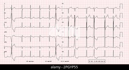 EKG-Beispiel eines 12-Kanal-Rhythmus, Ventrikulärer Bigeminus, reale Untersuchung Stockfoto