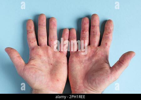 Schmerzhafter Ausschlag, rote Flecken Blasen an der Hand. Nahaufnahme Allergieausschlag, menschliche Hände mit Dermatitis und Gesundheitsproblem. Erkrankte Ekzemhaut des Patienten. Viral Stockfoto