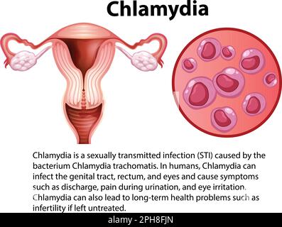 Chlamydia trachomatis mit erläuternder Darstellung Stock Vektor