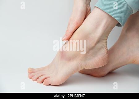 Verstauchtes Knöchel mit Bluterguss und Schwellung auf einem weiblichen linken Fuß auf weißem Hintergrund. Stockfoto