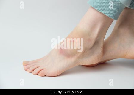 Verstauchtes Knöchel mit Bluterguss und Schwellung auf einem weiblichen linken Fuß auf weißem Hintergrund. Stockfoto