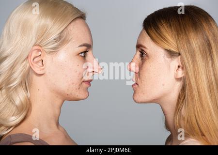 Seitenansicht von Modellen mit problematischer Haut, die sich von Angesicht zu Angesicht betrachten, isoliert auf grauem Rohteilbild Stockfoto