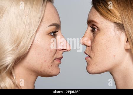 Profil von Frauen mit problematischer Haut, die von Gesicht zu Gesicht isoliert auf grauem Stockbild stehen Stockfoto