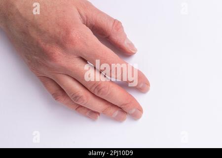 Nahaufnahme von weiblichen altersbezogenen Händen mit natürlich gebrochenen ungesunden, erkrankten Nägeln, überwucherter Kutikula auf weißem Hintergrund, Draufsicht, Kopierraum. Die Hand Stockfoto