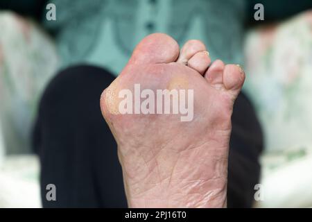 Ein Bunion, auch bekannt als Hallux valgus, ist eine Deformität des Gelenks, das den großen Zeh mit dem Fuß verbindet Stockfoto