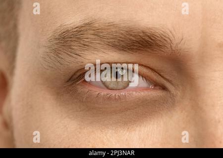 Müder Mann mit dunklem Kreis unter den Augen, Nahaufnahme Stockfoto