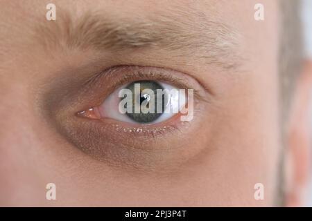 Müder Mann mit dunklem Kreis unter den Augen, Nahaufnahme Stockfoto