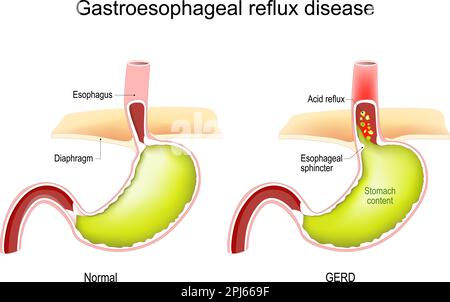 Gastroösophageale Refluxkrankheit. GERD. Querschnitt des menschlichen Magens. Normales inneres Organ und Magen mit saurem Reflux. Vektordarstellung Stock Vektor