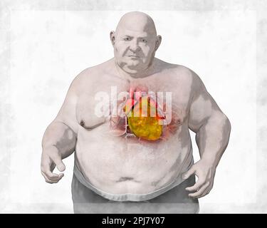 Fettherz beim übergewichtigen Mann, Illustration. Stockfoto