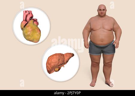 Fettherz und Leber beim übergewichtigen Mann, Illustration. Stockfoto