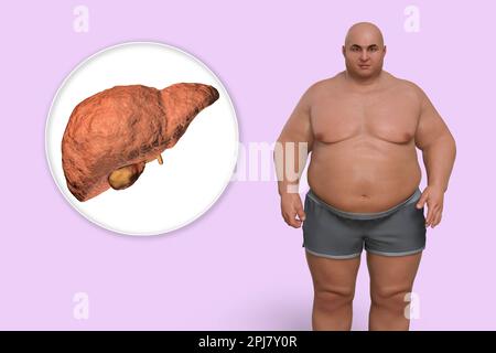 Fettlebererkrankung bei einem übergewichtigen Mann, Illustration Stockfoto