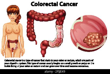 Kolorektales Karzinom mit erläuternder Darstellung Stock Vektor