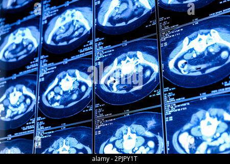 Computertomographie (CT-Scan) des Thorax mit Abdomen Stockfoto